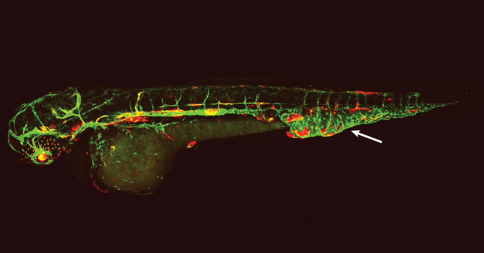 Zebrafish with fluorescently labeled lymphatic and blood vessels and vascular malformation in the tail.